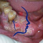 عوامل خطرساز سرطان دهان